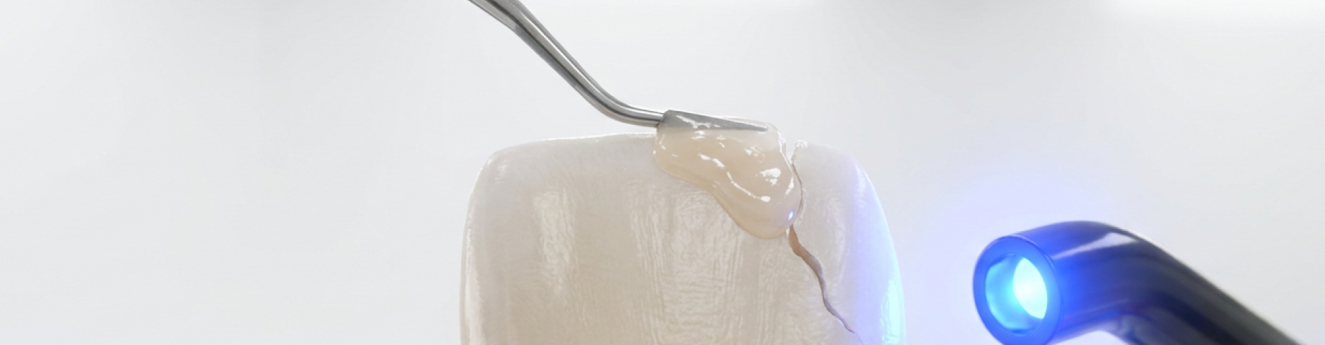 Close-up illustration of dental bonding material being applied to a cracked front tooth and hardened with a blue curing light.